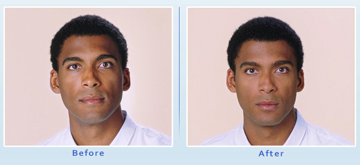 Beverly Hills Botox Results - After View