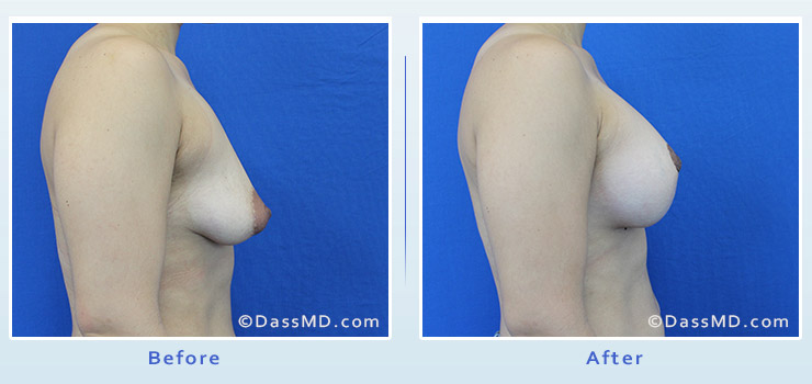 Breast Reduction case 3 before after image 3