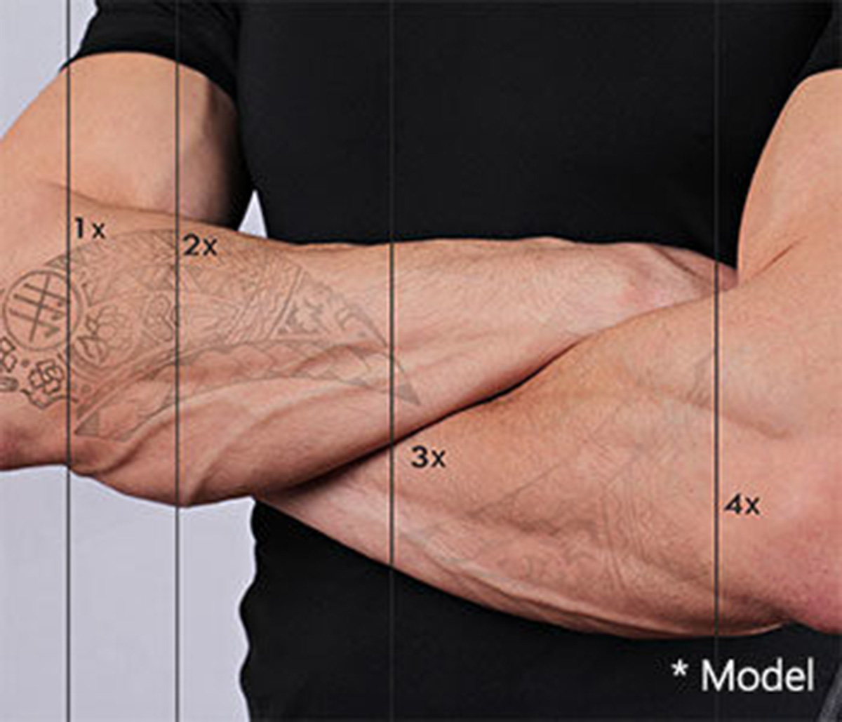 What are the cost and benefits of laser tattoo removal treatment in Beverly Hills, CA