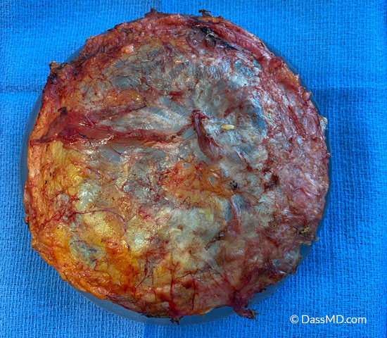 En bloc total capsulectomy