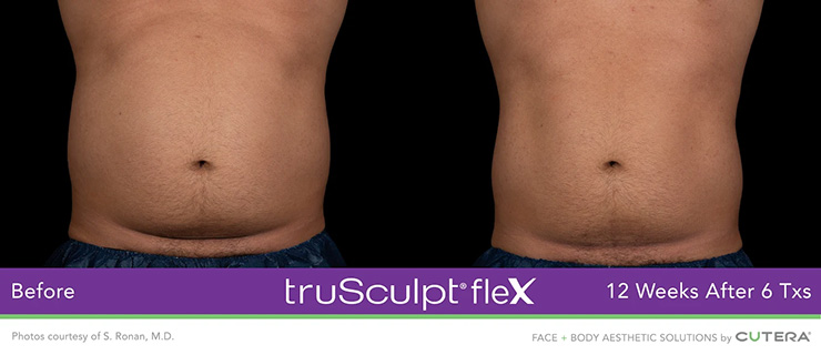 Dr Dennis Dass, TruSculpt Flex Before and After Image 3