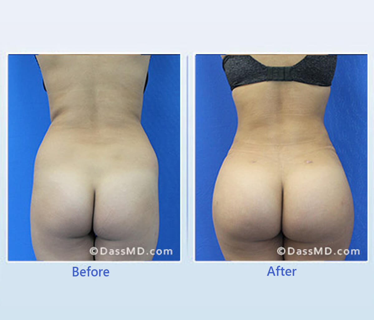 Before and After image of Brazilian Butt Lift in Beverly Hills CA Area